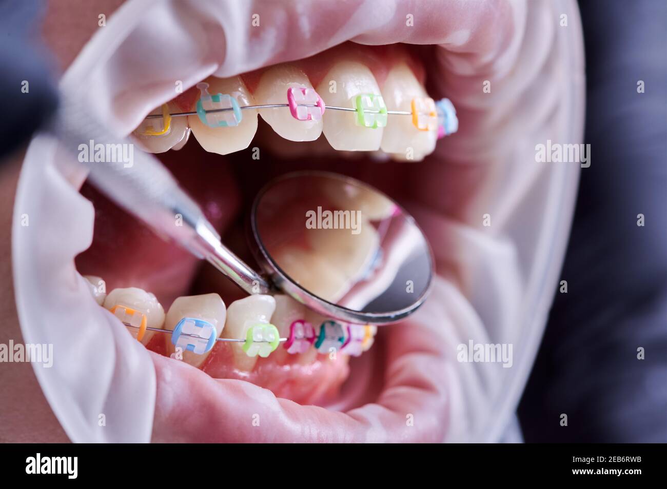 Close up of orthodontist checking patient brackets with dental mirror