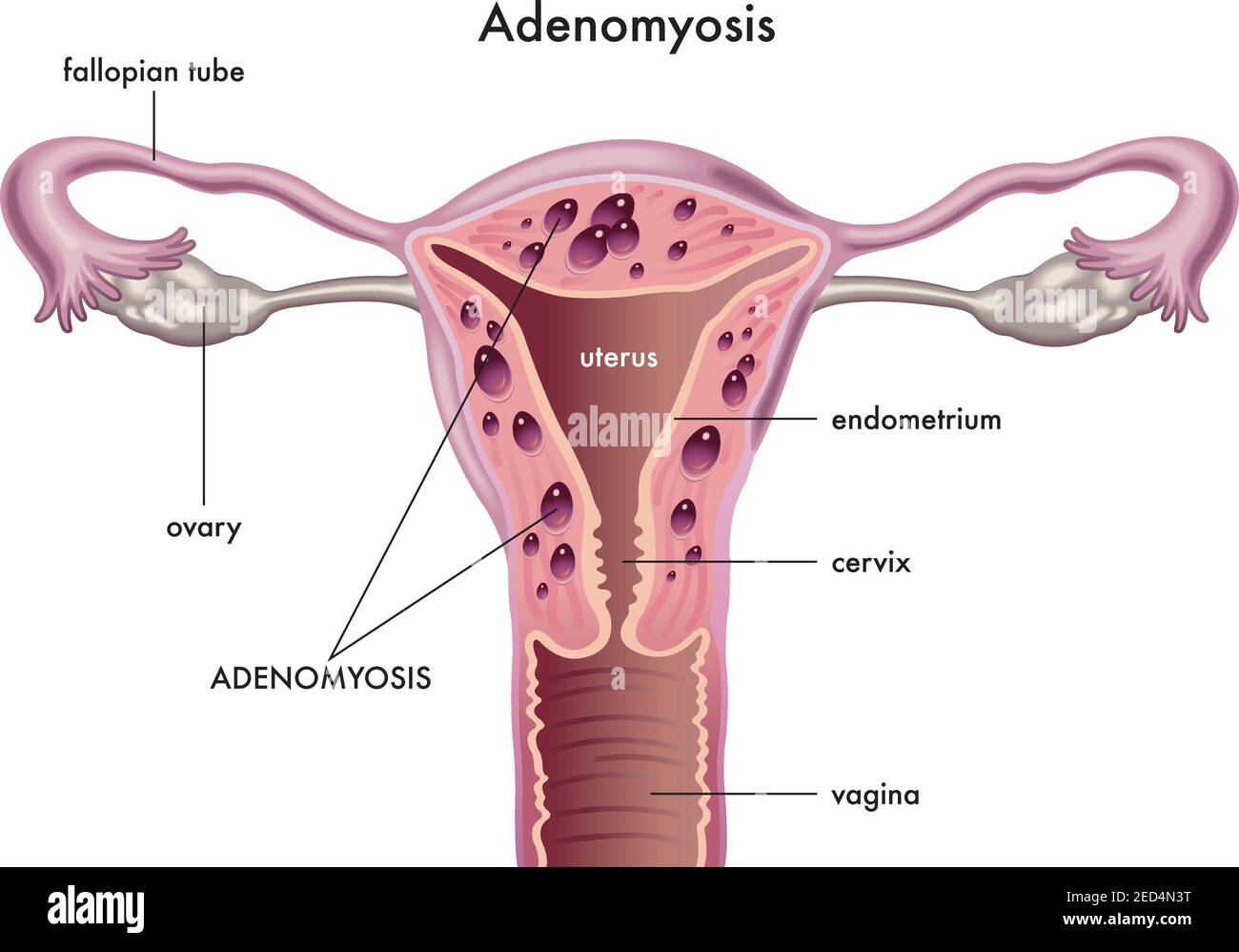 Anatomical illustration of the female reproductive system with the symptoms of adenomyosis, with annotations. Stock Vector