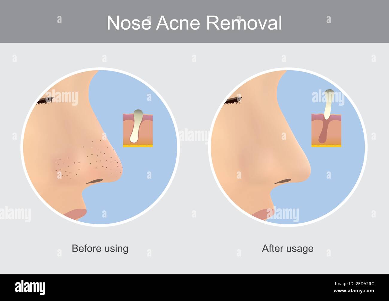 Nose Acne Removal. Illustration show human skin in case before using and after usage a products for the nose acne (blackhead) remover. Stock Vector