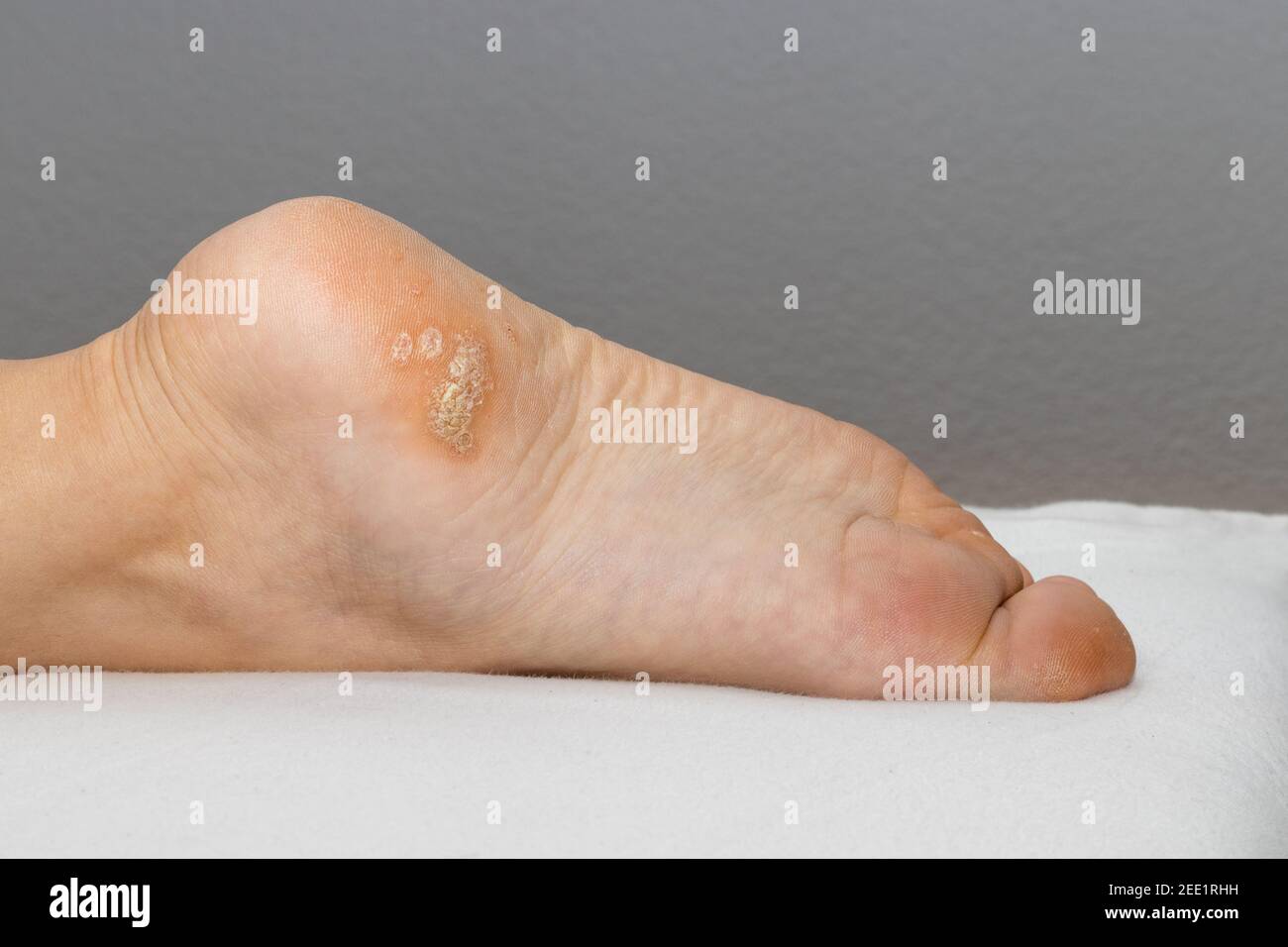 Viral warts on sole foot hires stock photography and images Alamy