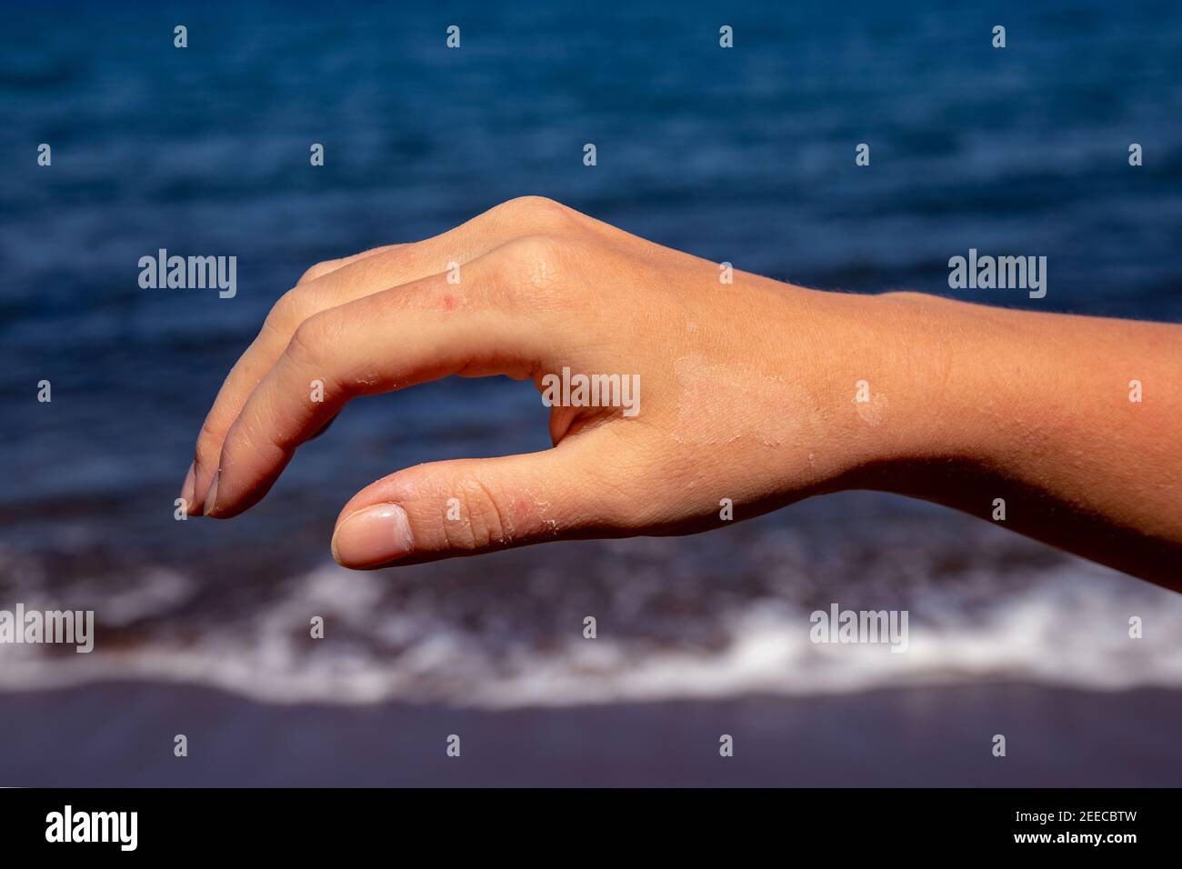 Female hand with red sunburn skin on blue sea background. Sun burned skin peeling. Seaside threat. Dangerous sun of tropical country. Summer vacation Stock Photo