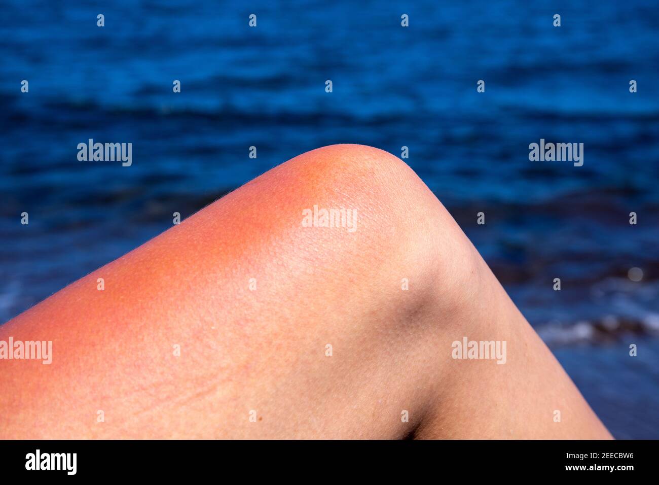 Woman leg with red sunburn skin on blue sea background. Sun burned skin redness and irritation. Dangerous sun of tropical country. Summer vacation hea Stock Photo