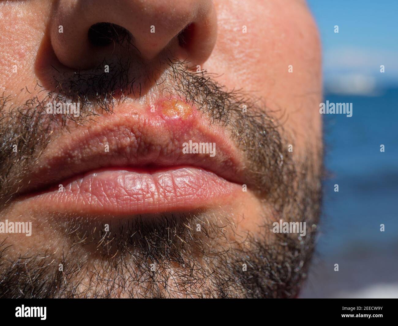 Infection on man face closeup. Sun burn or bacterial infection on face