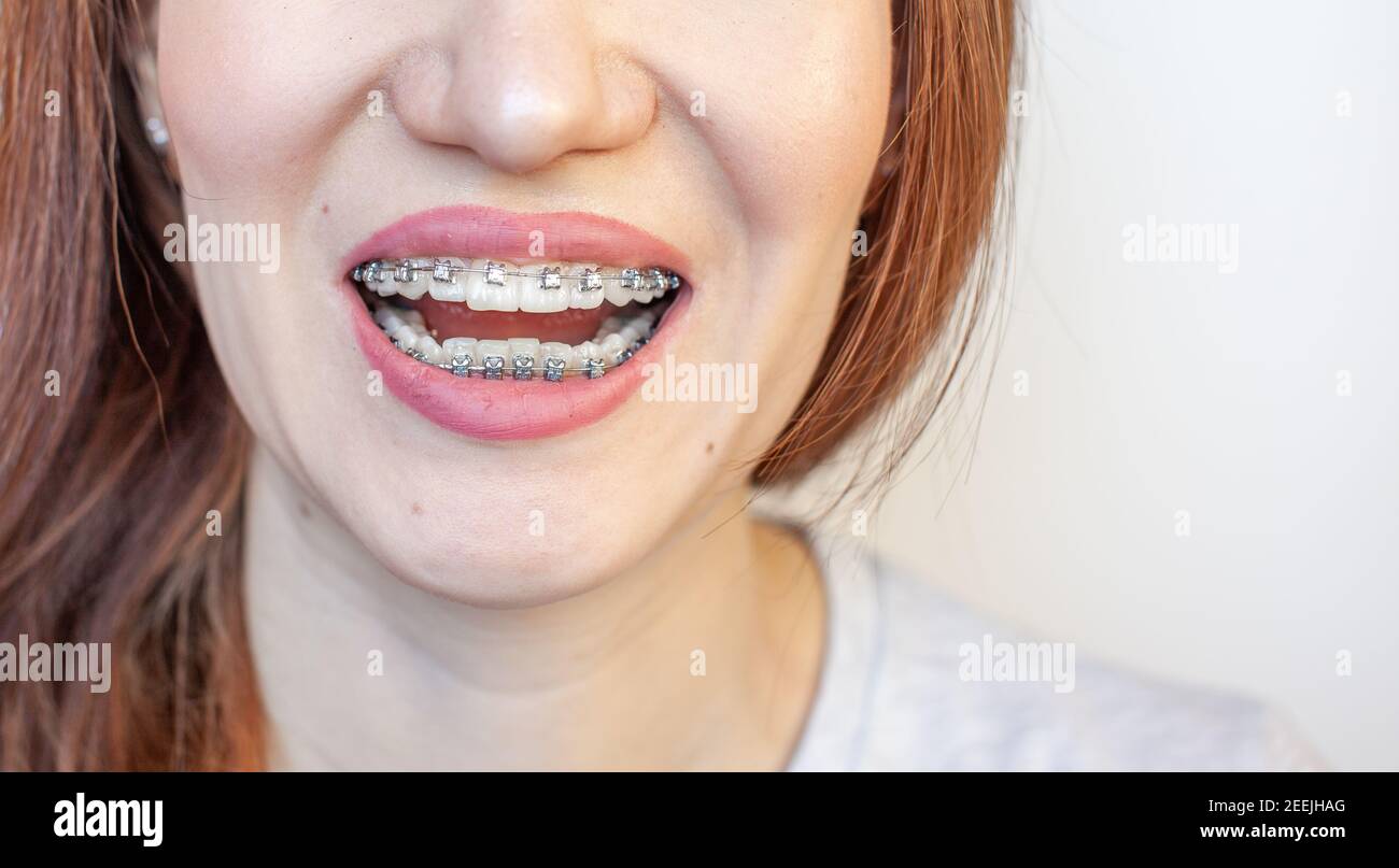 Orthodontic elastic bands hires stock photography and images Alamy