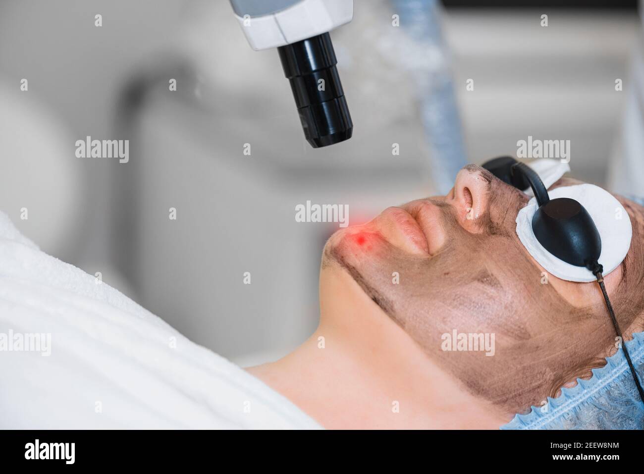 Close-up of laser peeling of facial skin. Girl doing carbon pilling procedure. Stock Photo