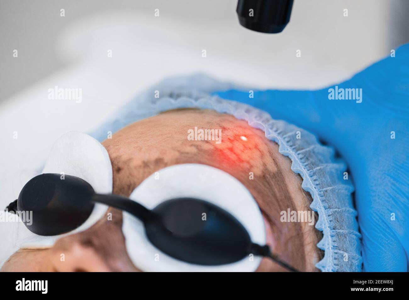 Laser carbon fiber pilling of the face skin close-up. Laser skin rejuvenation. Stock Photo