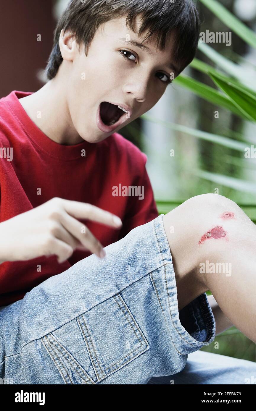 Portrait of a boy with wounds on his knee Stock Photo