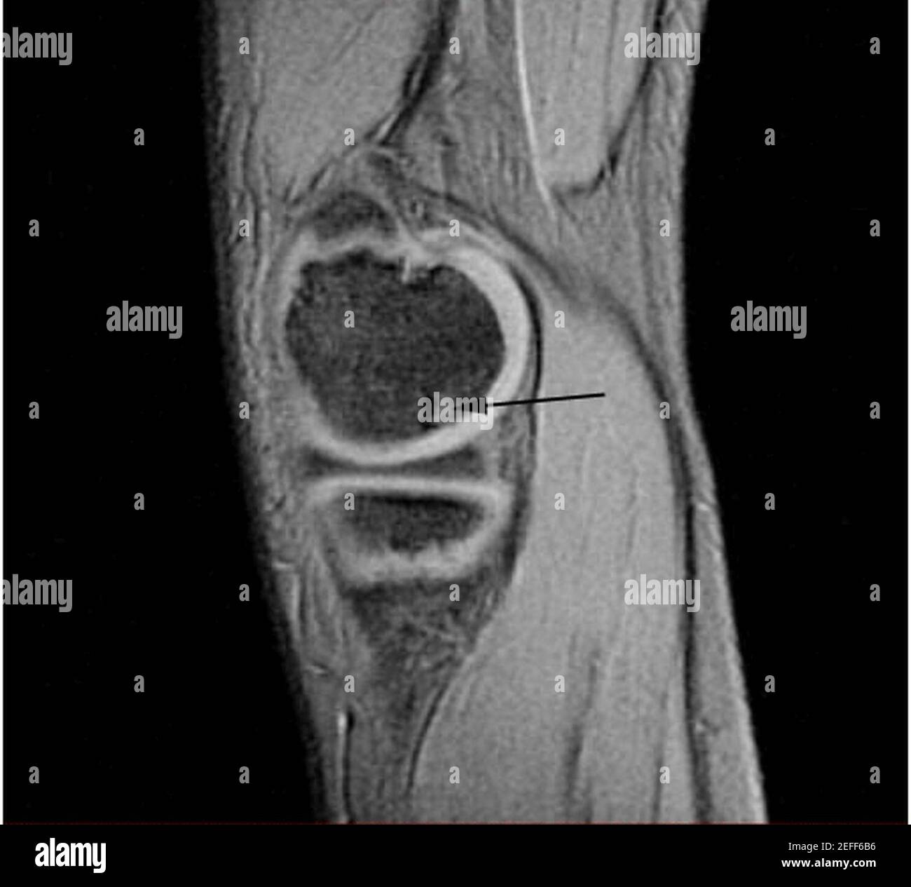 OCD WalterReed MRI-Sagital-T2 Stock Photo - Alamy