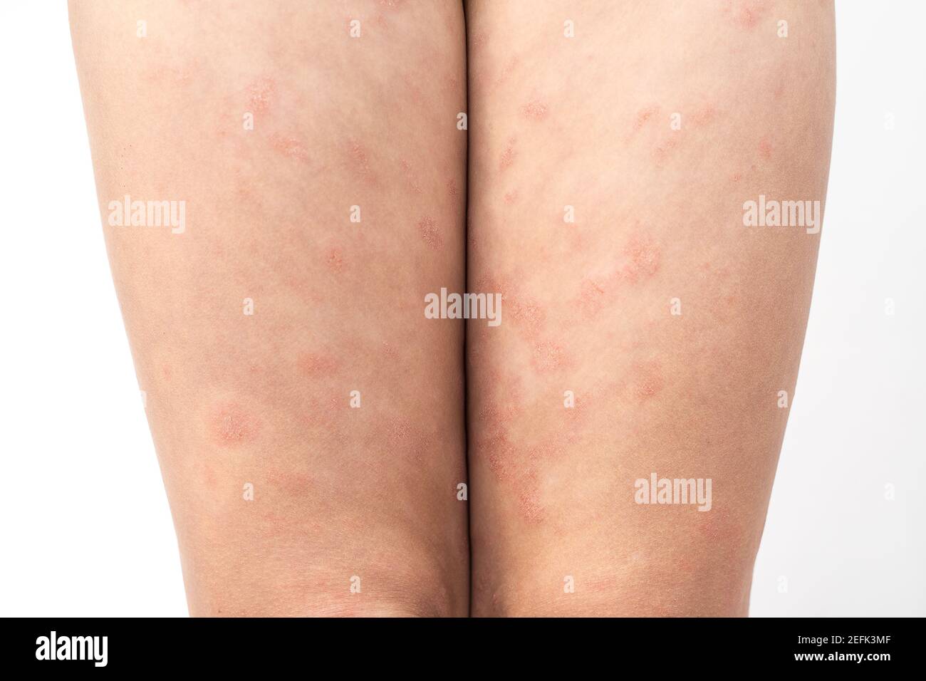 Acute atopic dermatitis on the feet of a child is a dermatological skin disease. Large, red, inflamed, scaly rash on the legs. Legs of a teenager with Stock Photo