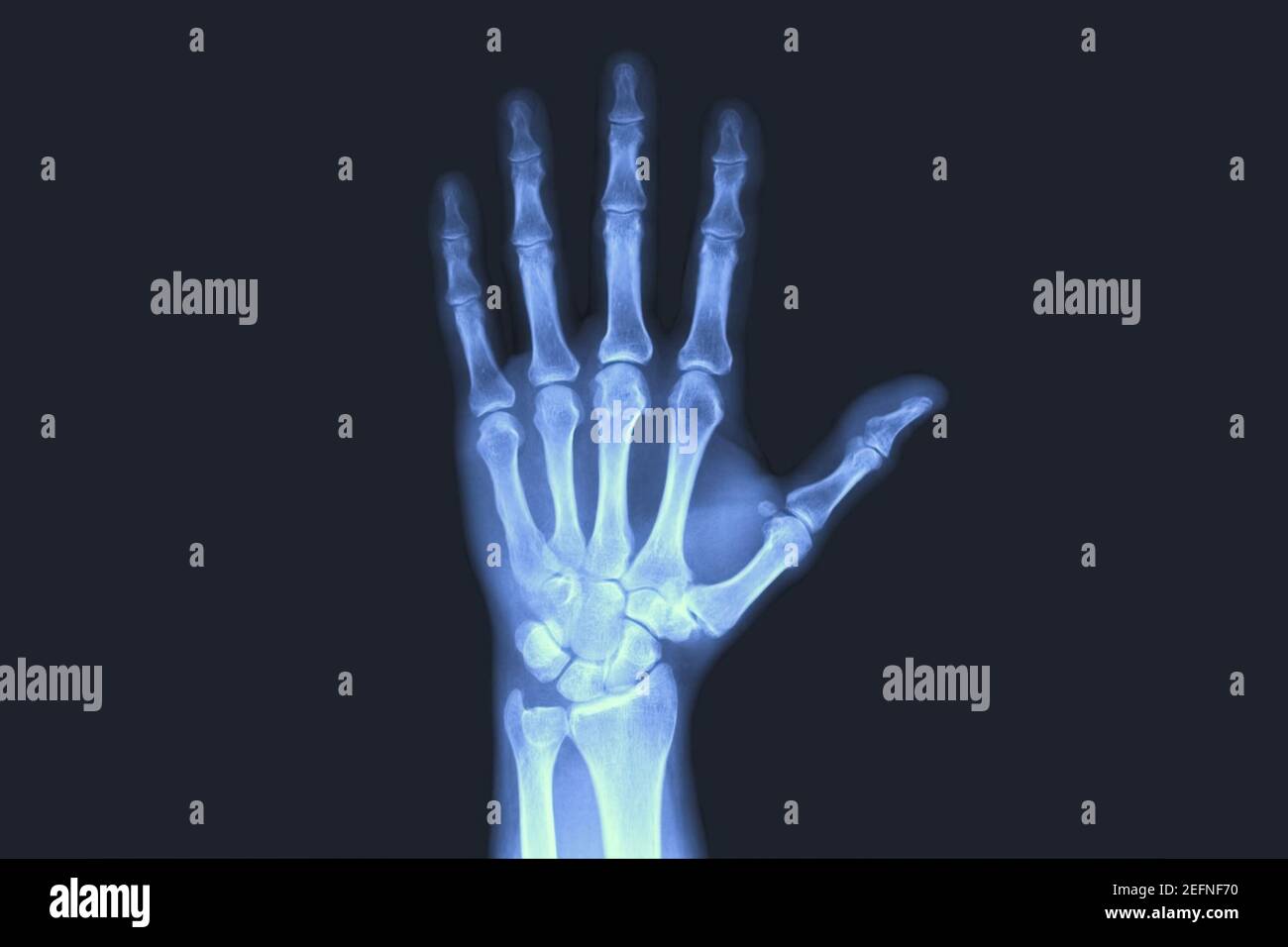 Xrayed human hand. Xray of hand bones Stock Photo Alamy