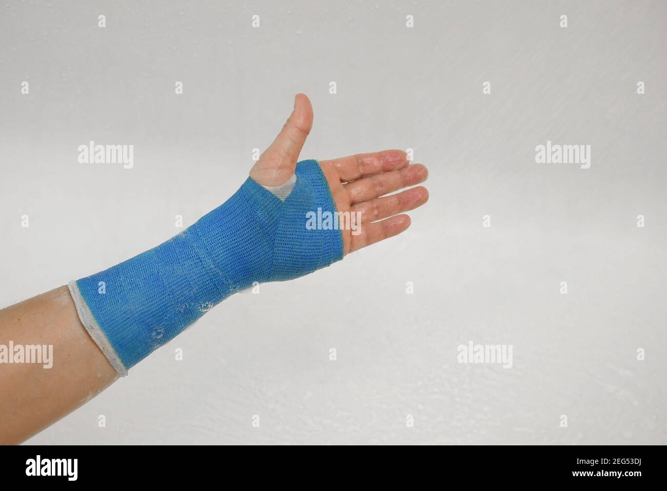 Hand wrapped in fiberglass modern waterproof bandage Stock Photo Alamy