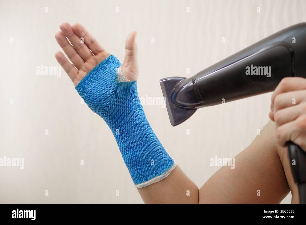 Hand wrapped in fiberglass modern waterproof bandage Stock Photo Alamy