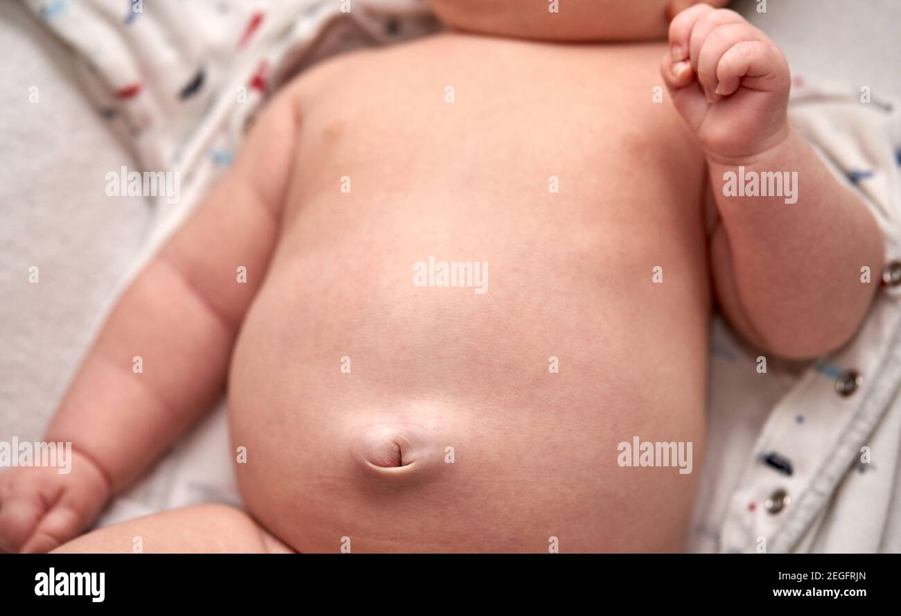 Umbilical hernia in baby hi-res stock photography and images - Alamy