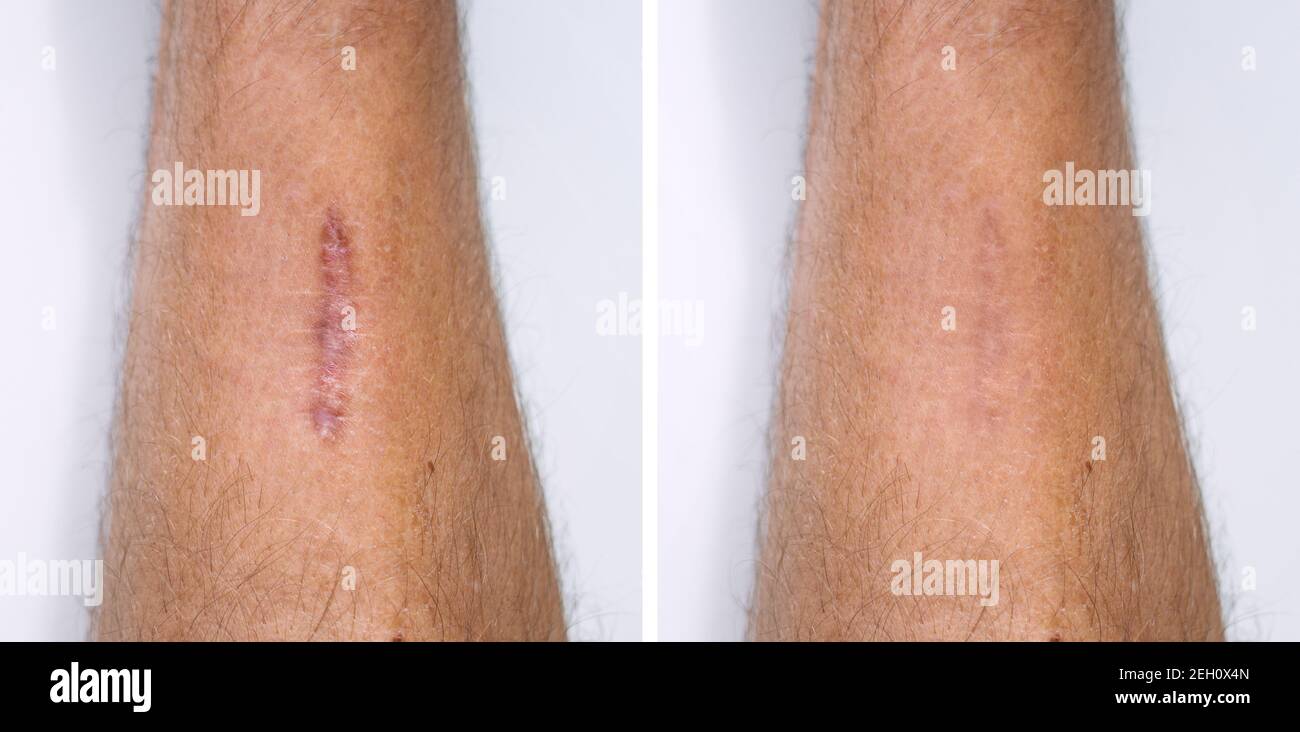 Result after procedure of scar removing. Scar surgery or laser removal. Skin imperfections or defects before and after treatment Stock Photo