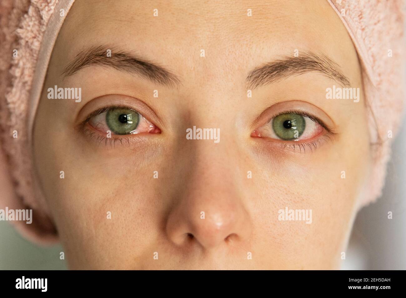 Close up of a woman with irritated reddened eyes. Lenses cause eye inflammation Stock Photo Alamy