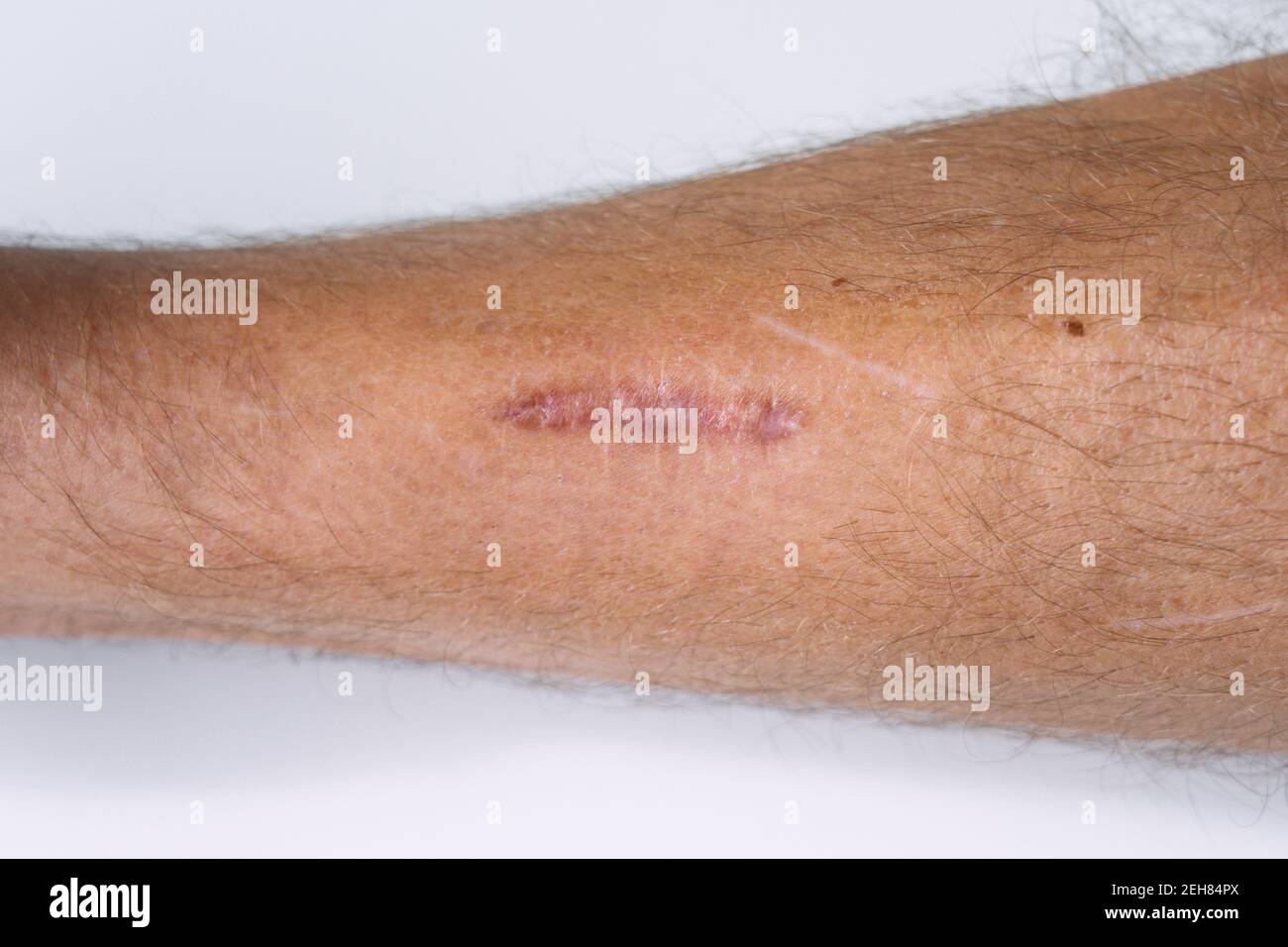 Mans leg with scar after stitched wound. Scar that was raised after being sewn Stock Photo