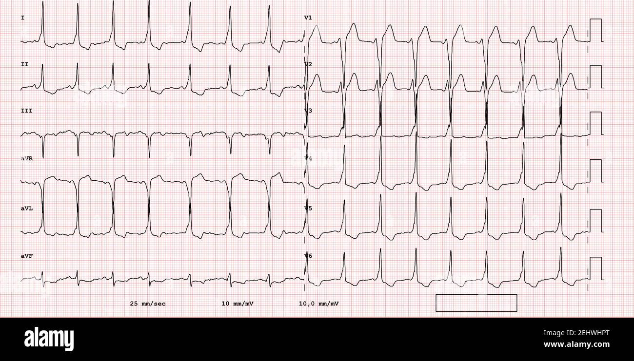 ECG example of a pathological 12-lead rhythm, supraventricular ...