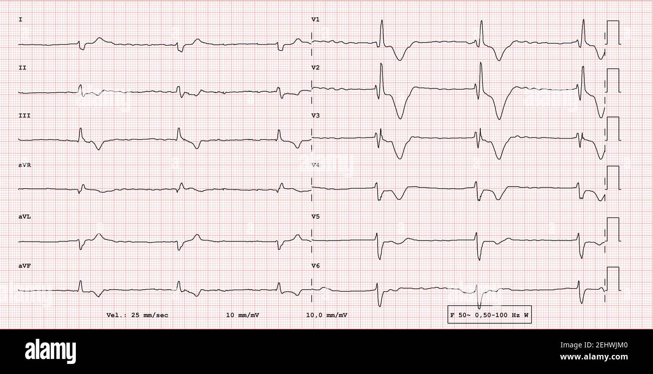 ECG example of a pathological 12-lead rhythm, atrial fibrillation  with total block Stock Photo