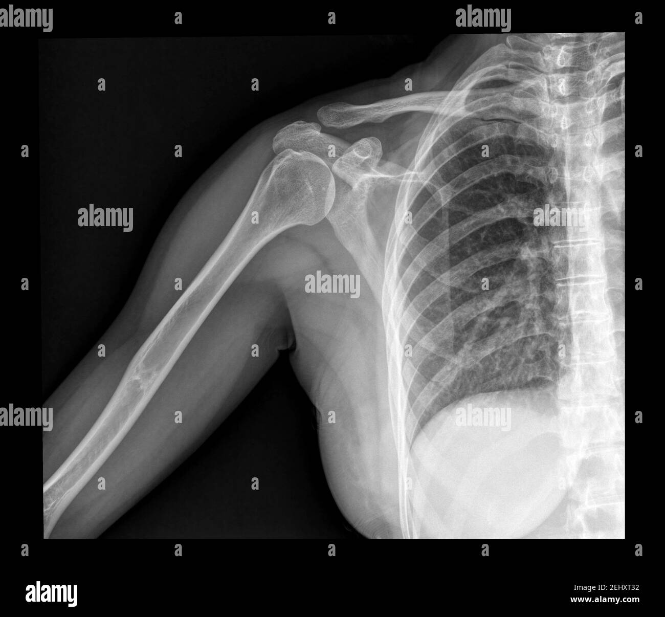 x-ray shoulder radiograph displaying Acromioclavicular sprain disruption, sports injury Stock Photo