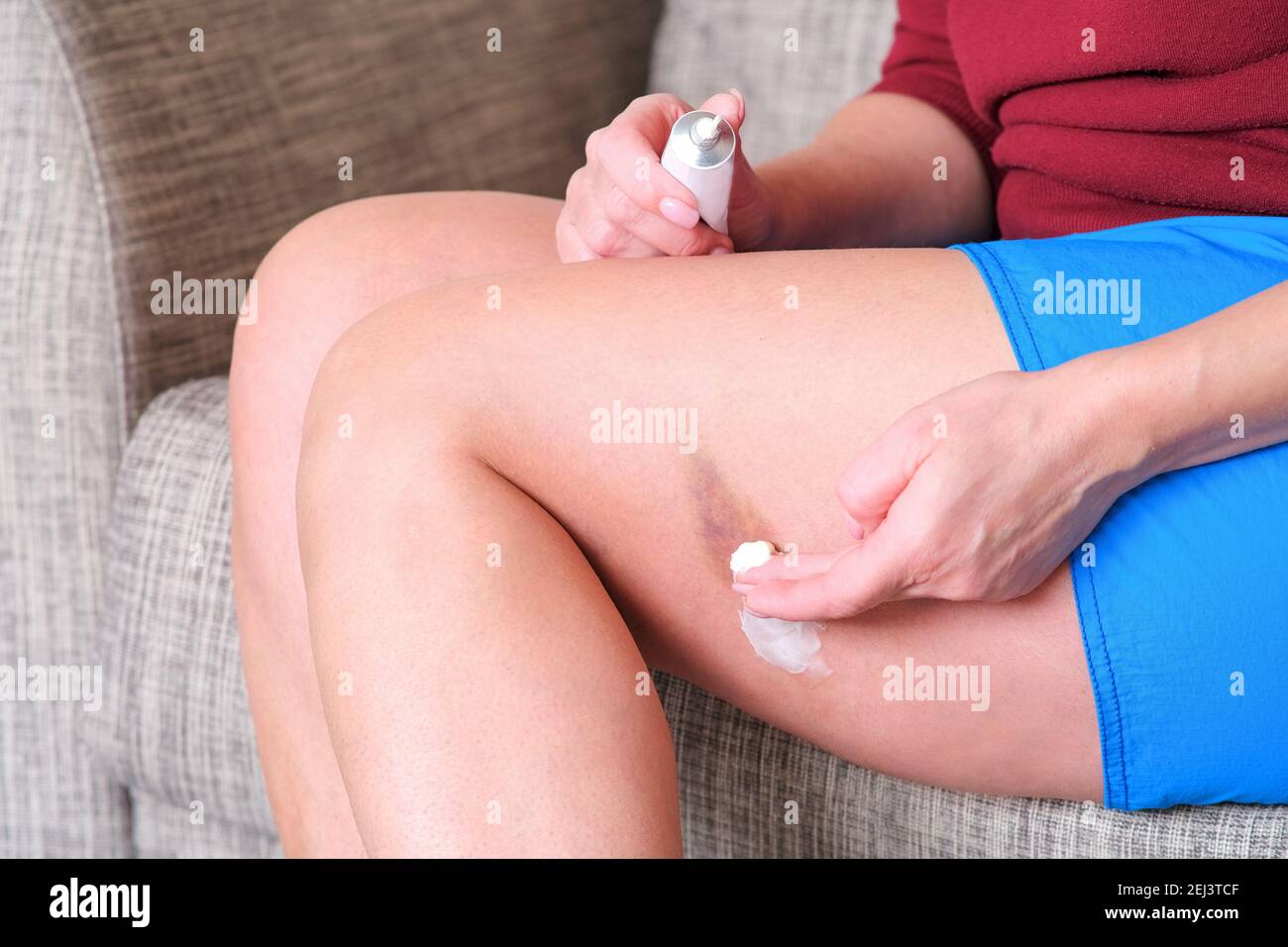 A bruise on my leg. Pain in the leg. Cream for hematomas. Skin care for a young woman. A healthy female body Stock Photo