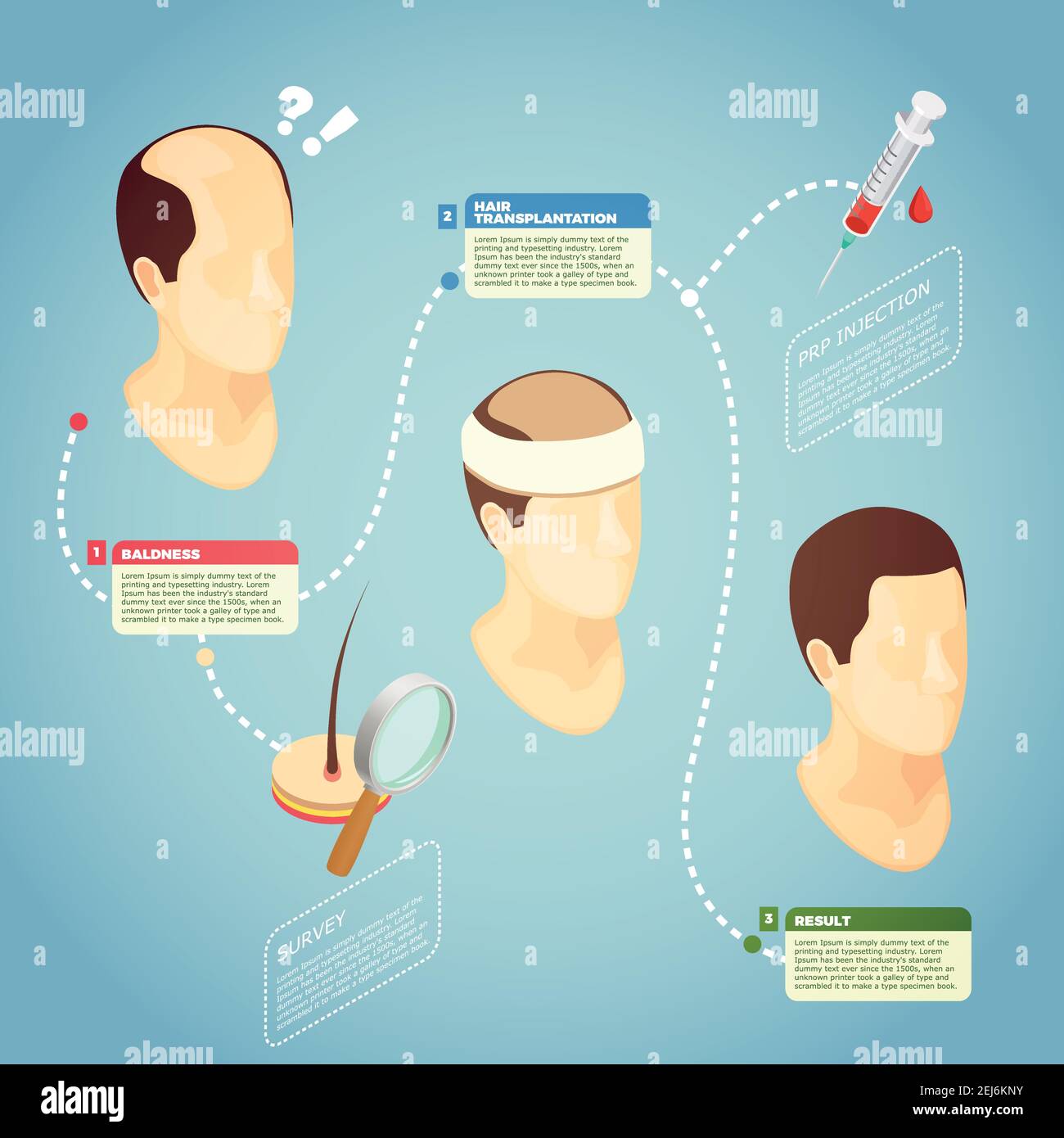 Hair transplantation isometric vector illustration with description surgery procedure of restore hair on bald head Stock Vector