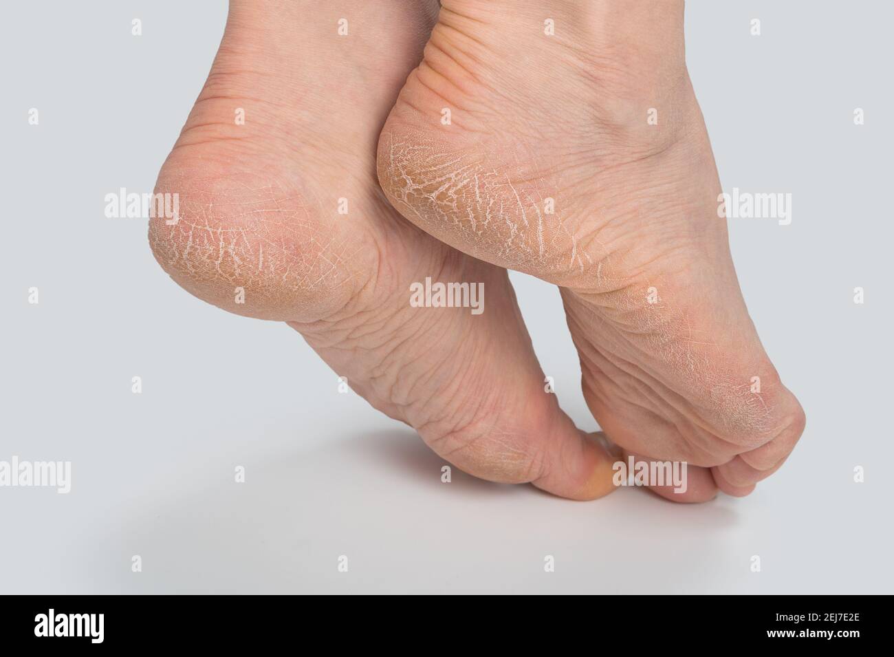 Dry and cracked soles of feet on white background, womans feet with dry heels, cracked skin. Close up of Cracks on Heels with bad skin covered. Health Stock Photo