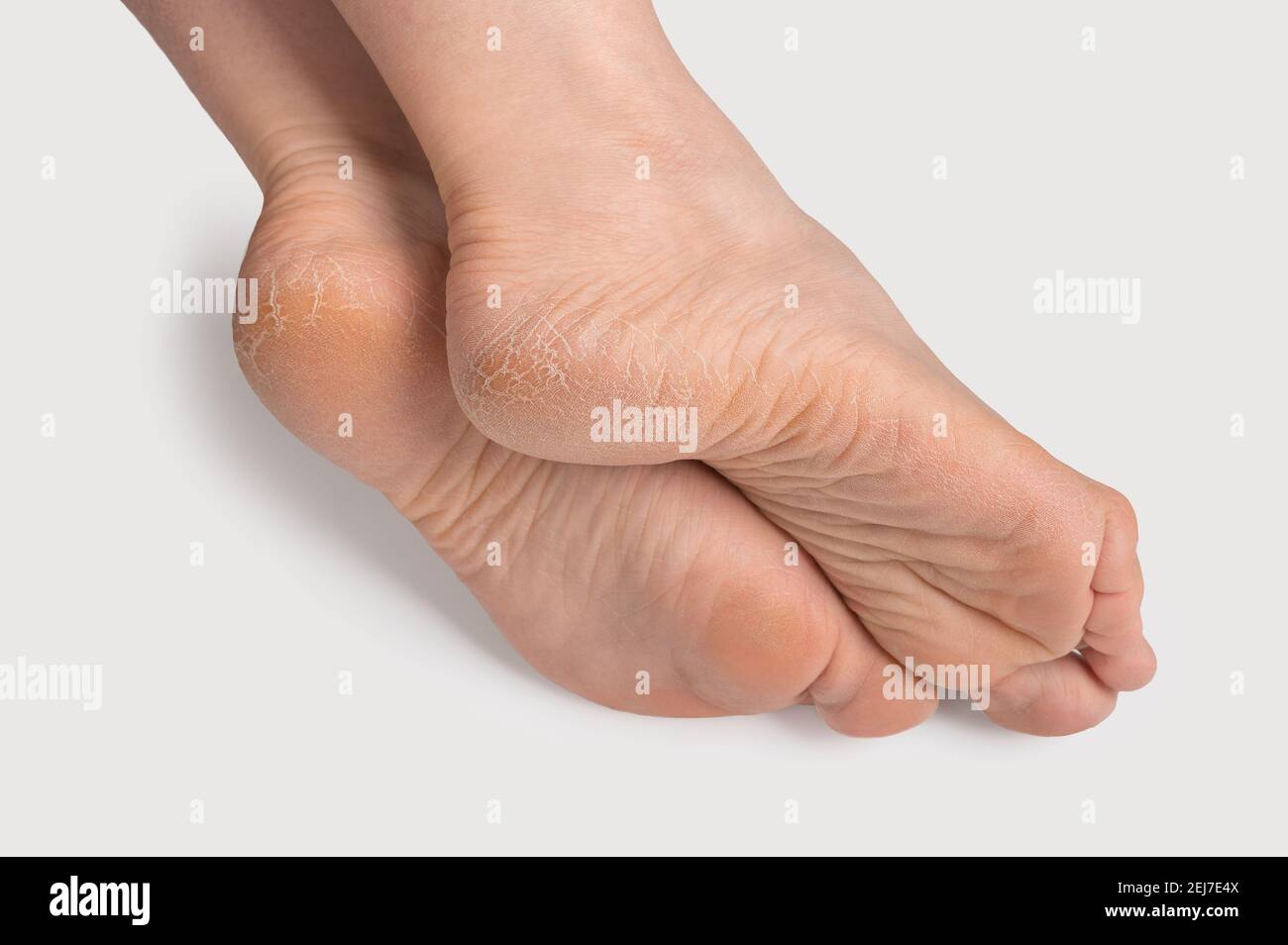 Dry and cracked soles of feet. female legs, feet, foot in an elegant