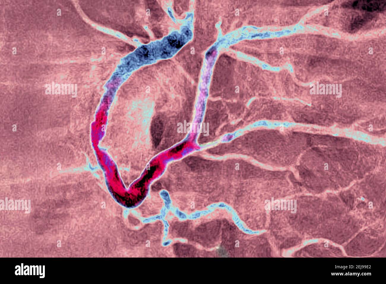 Myocardial infarction with a significant thrombus Stock Photo