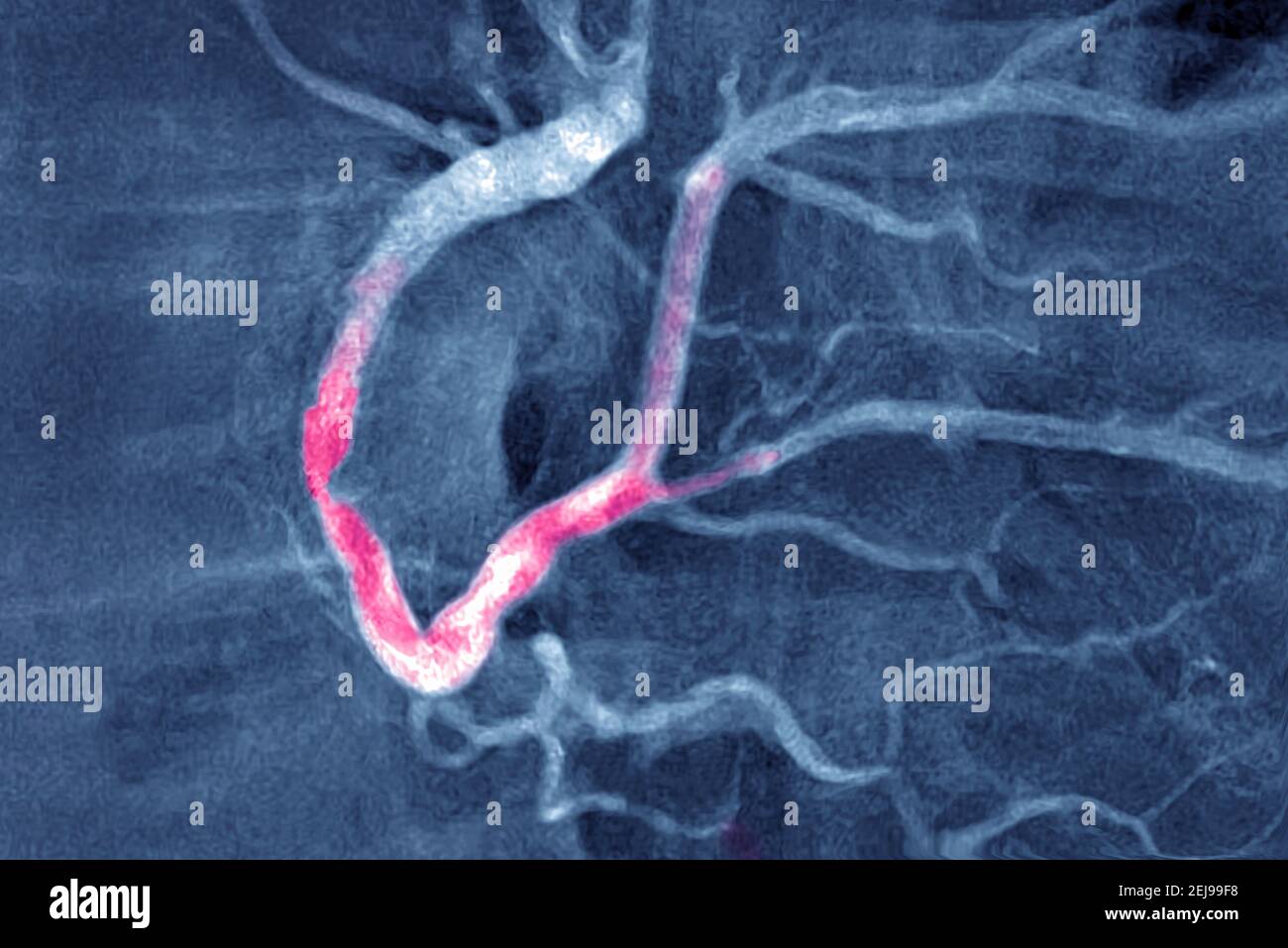 Myocardial infarction with a significant thrombus Stock Photo
