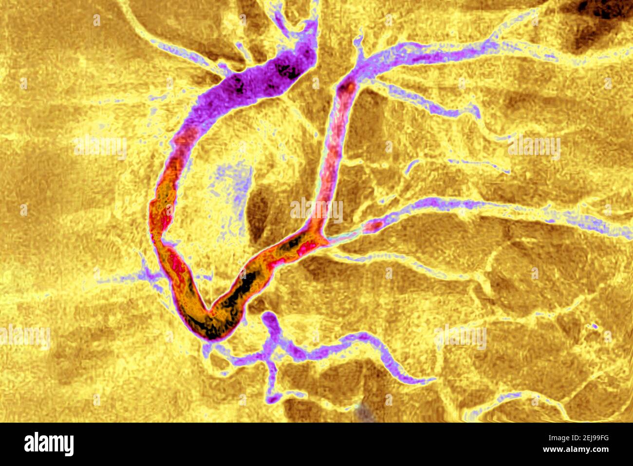 Myocardial infarction with a significant thrombus Stock Photo