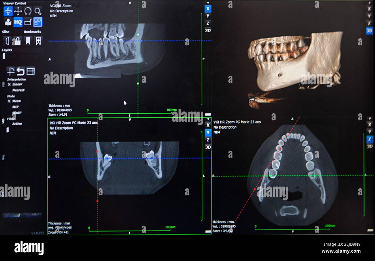 3D reconstruction from a CT image of a patient's jaw for personalized 3D printing. Stock Photo