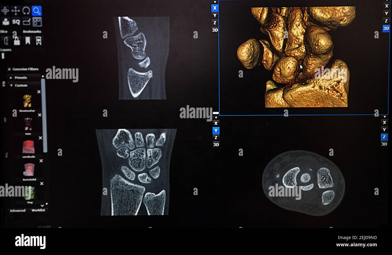 3D reconstruction from a CT image of a patient's wrist for personalized