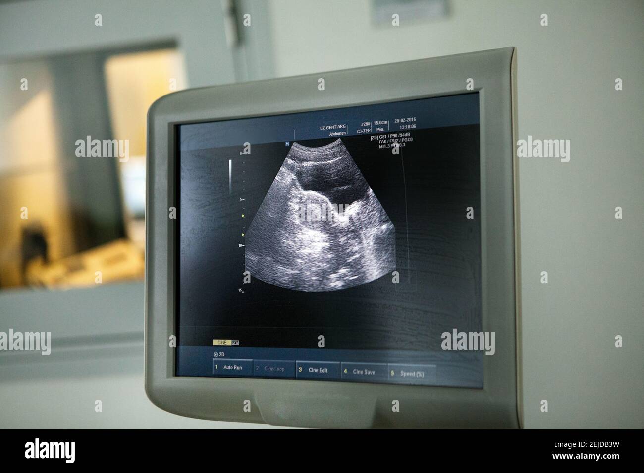 IVF performed in a lesbian couple: ultrasound image of the embryo transfer. Stock Photo