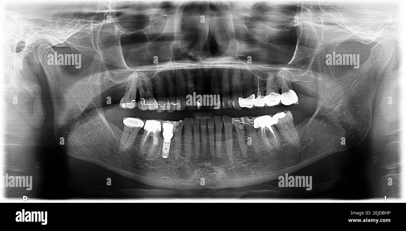 Colorized jaw xray. Presence of implants and dental crowns Stock Photo