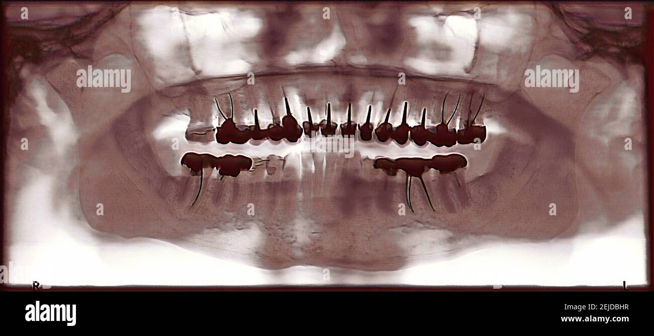 Colorized jaw xray. Presence of dental crowns Stock Photo Alamy