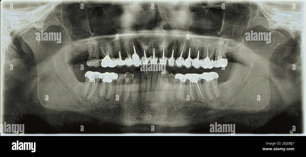 Colorized jaw xray. Presence of dental crowns Stock Photo Alamy