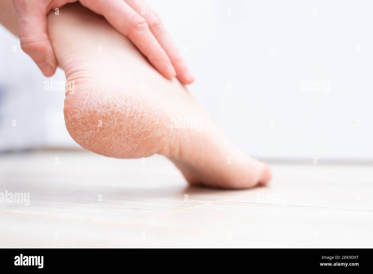The dry skin on the heel is cracked. Treatment concept with moisturizing creams and exfoliation for healing wounds and pain when walking. Dehydrated Stock Photo
