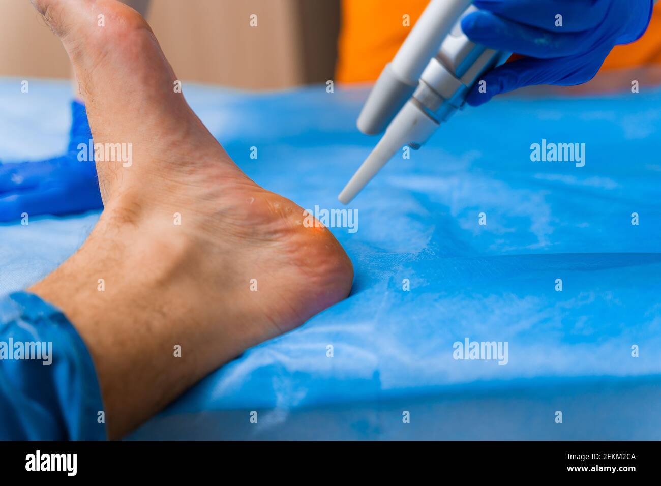Laser removal of warts on the foot. Medical dermatological surgery in the clinic Stock Photo Alamy