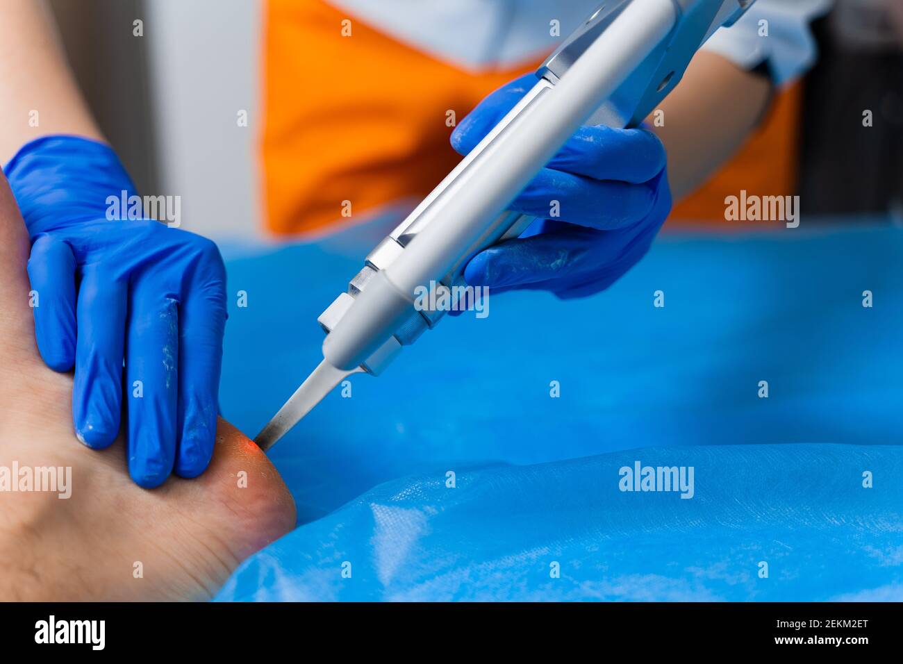 Laser removal of warts on the foot. Medical dermatological surgery in the clinic Stock Photo Alamy