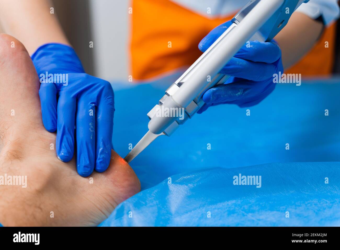 Laser removal of warts on the foot. Medical dermatological surgery in the clinic Stock Photo Alamy