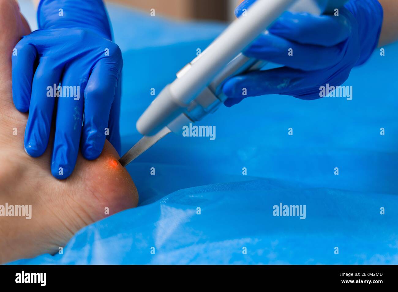 Laser removal of warts on the foot. Medical dermatological surgery in