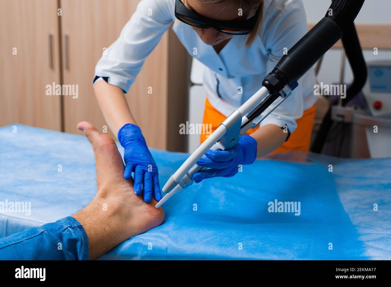 Laser removal of warts on the foot. Medical dermatological surgery in