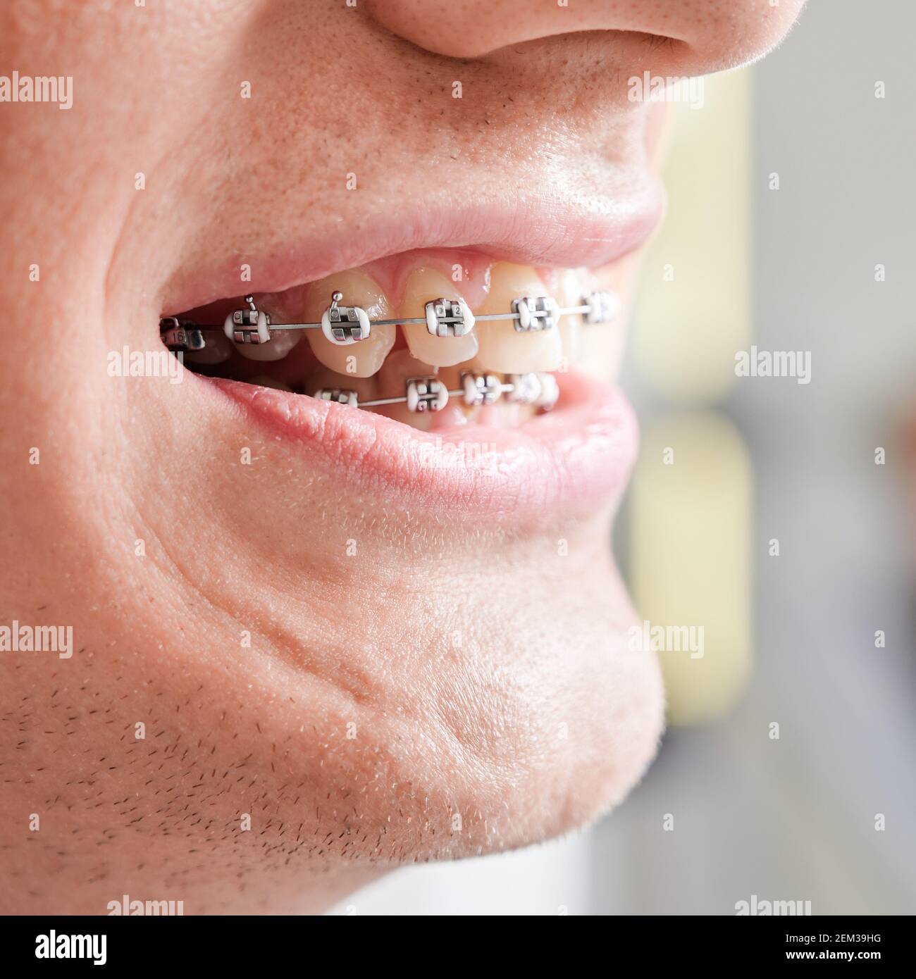 Cropped, closeup, macro photography of man's smile with metal braces on his teeth. Orthodontic treatment. Side view. Concept of medicine and dentistry Stock Photo