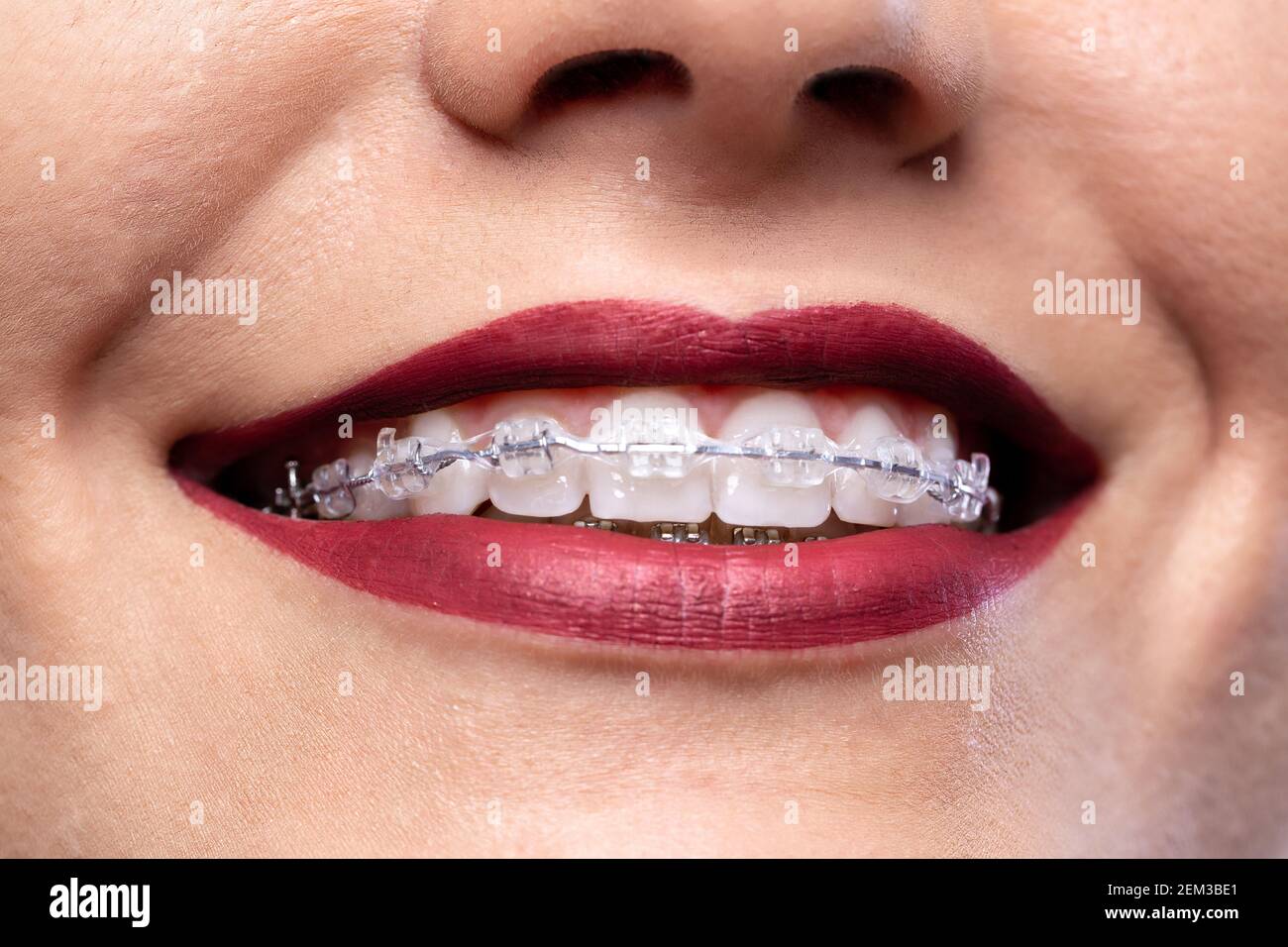 Beautiful smile, teeth and braces, white teeth concept Stock Photo - Alamy