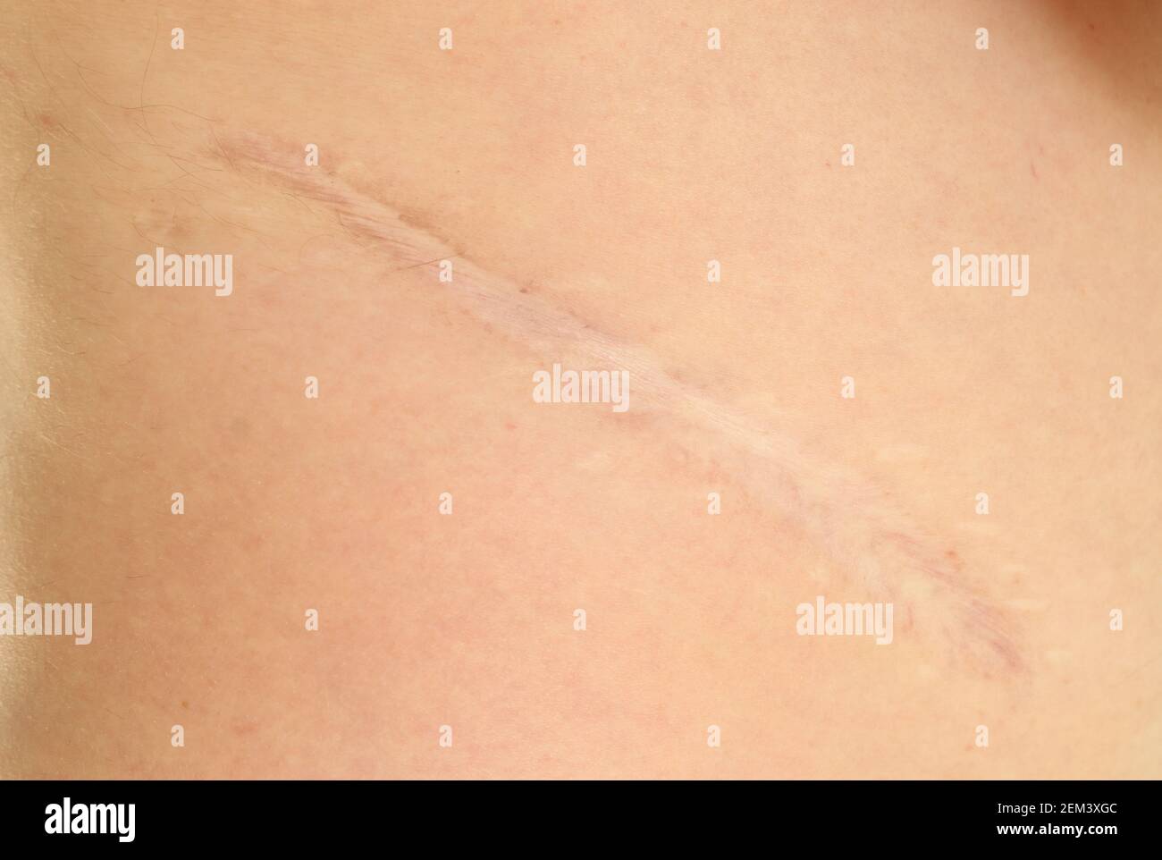 Cicatrice scar on forty years old man side after kidney surgery undergone in childhood Stock Photo