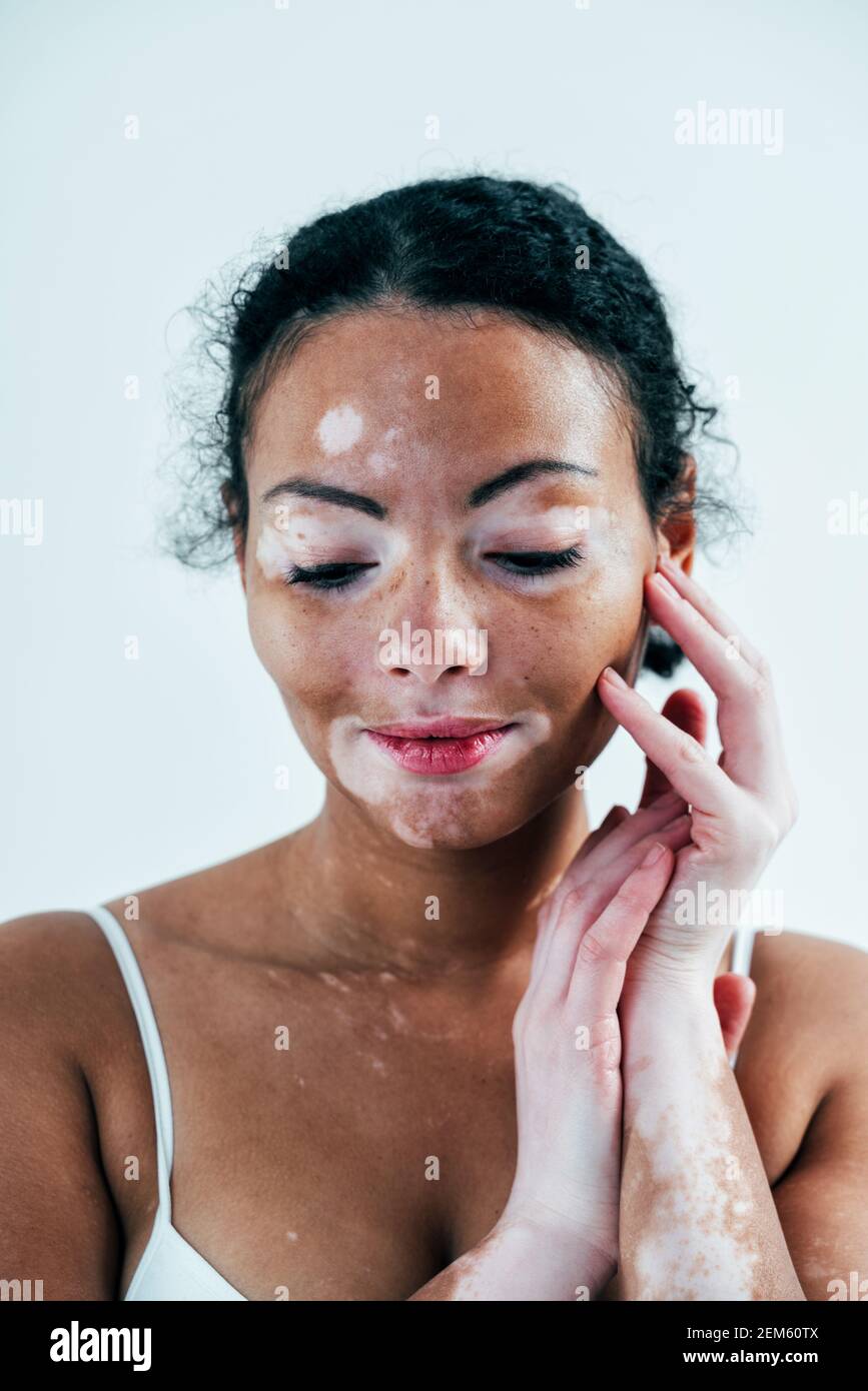 Beautiful woman with vitiligo skin posing in studio. Concept about body  positivity and self acceptance Stock Photo - Alamy