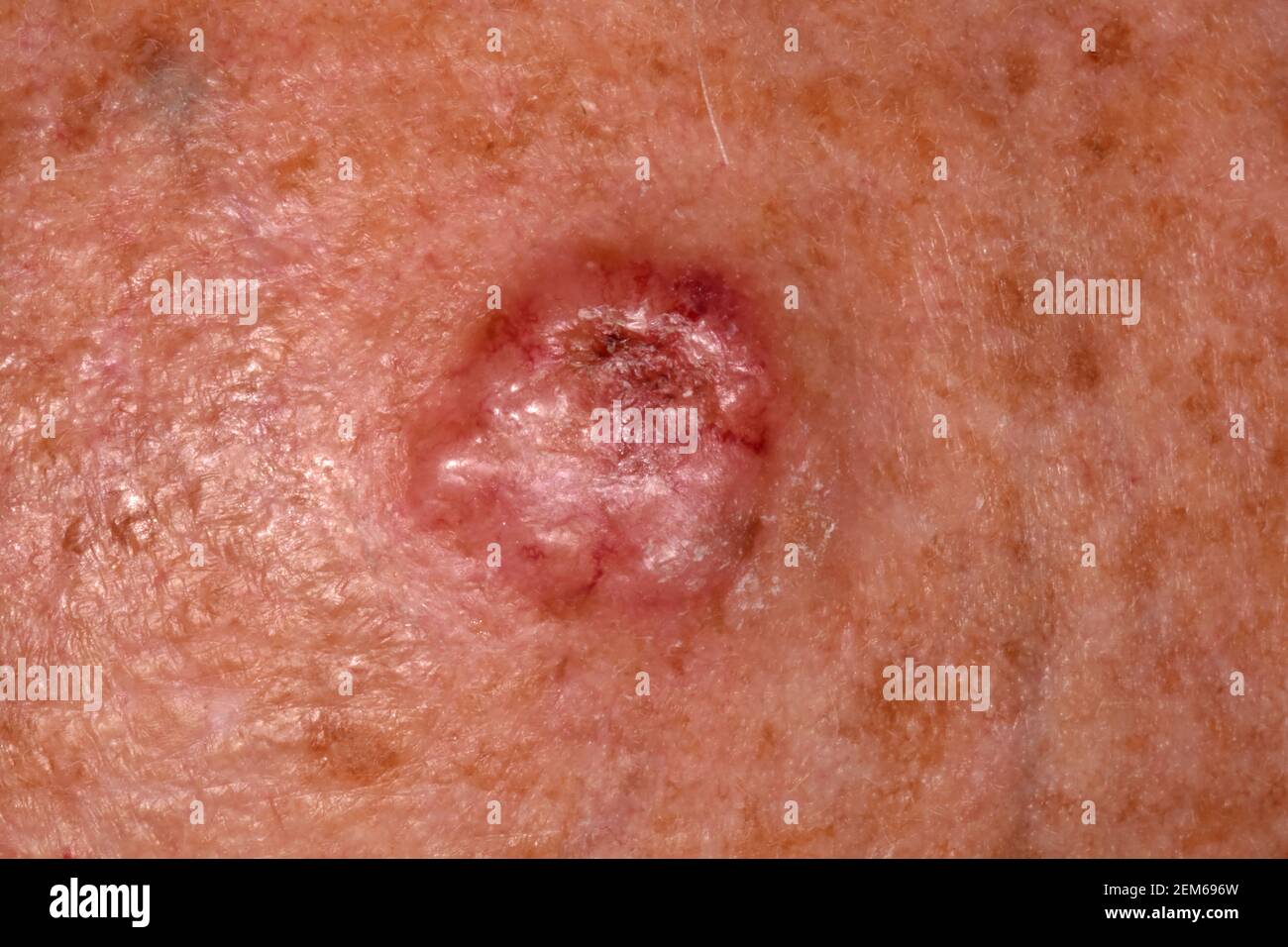 Secondary Skin Cancer On The Forehead Stock Photo Alamy