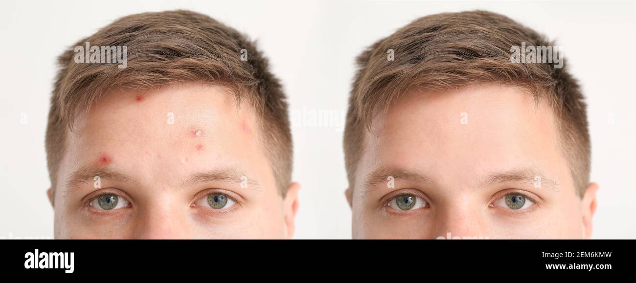 Teenage boy before and after acne treatment on white background Stock ...