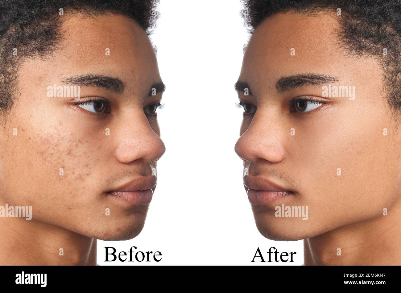 AfricanAmerican teenage boy before and after acne treatment on white