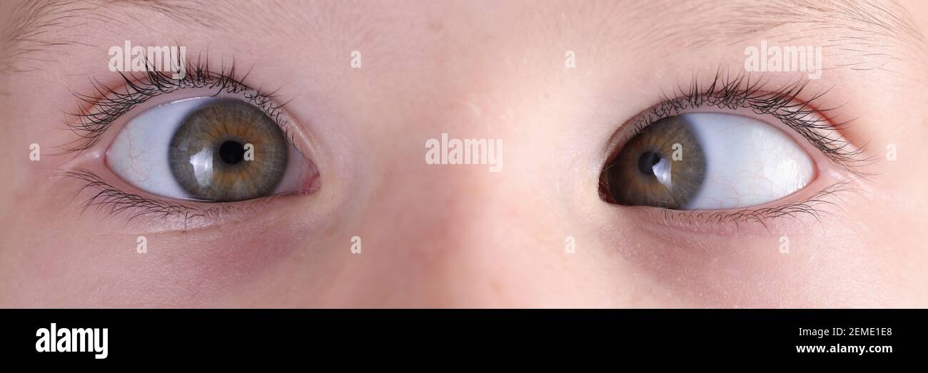 Child's face with squint and freckles on nose Stock Photo Alamy